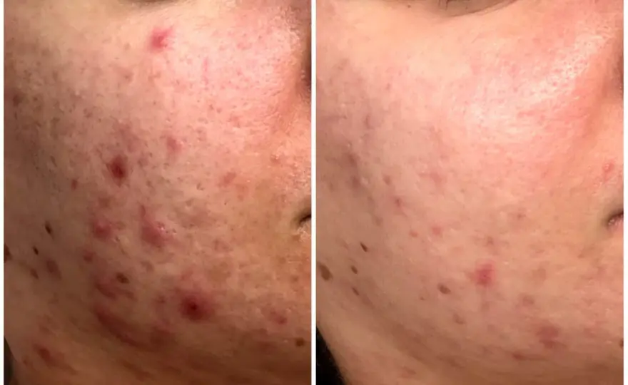 Trądzik hormonalny - Jak skutecznie go wyleczyć bez chaosu?