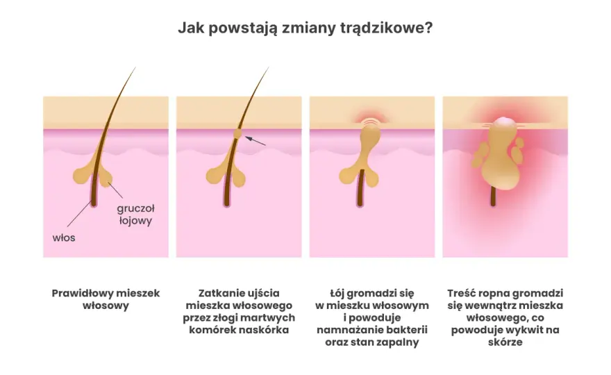 Trądzik bakteryjny - jak rozpoznać zmiany i je leczyć?