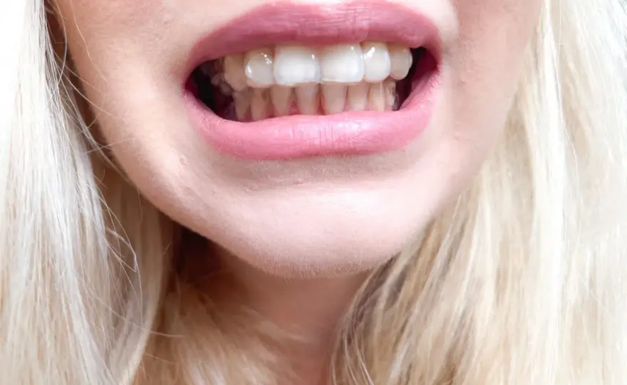 Nakładki Invisalign - czy warto? Pełny przewodnik i koszty