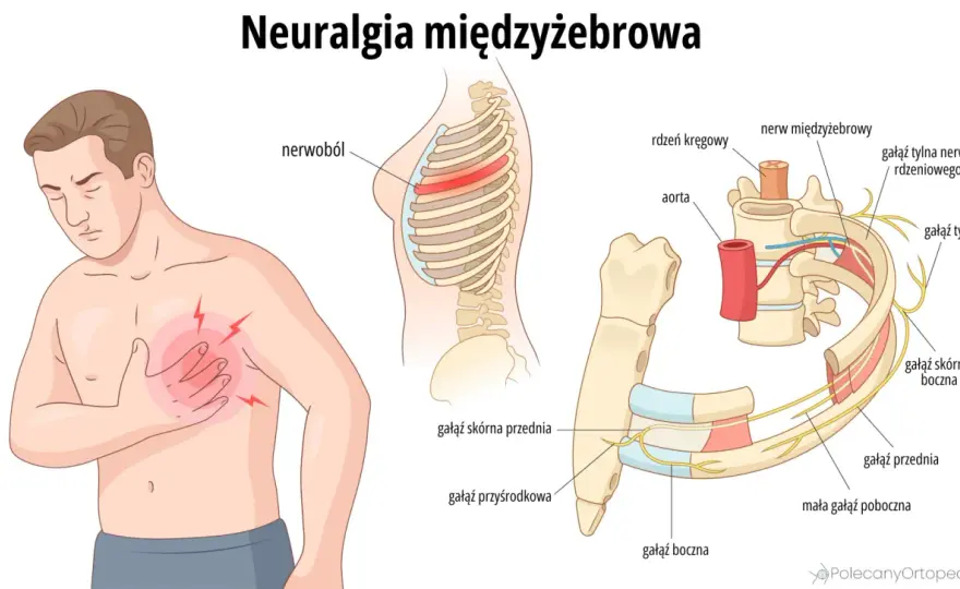 Ból korzeniowy czy przeciążenie? Rozpoznaj objawy i działaj!