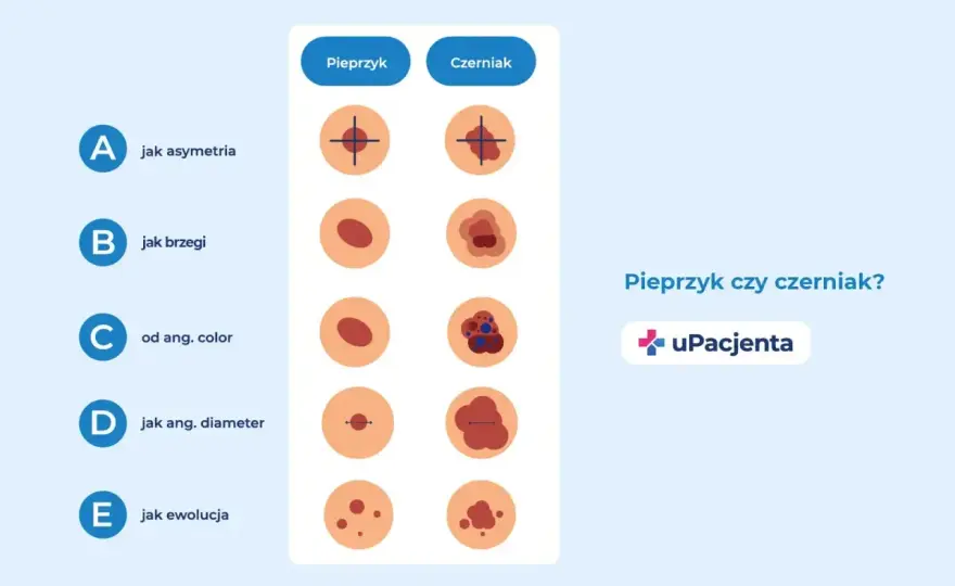 Swędzący pieprzyk - Kiedy iść do lekarza?