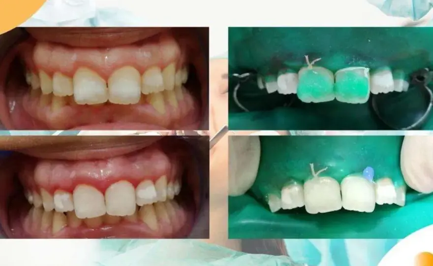 Macchie bianche sui denti - Cause e trattamenti efficaci