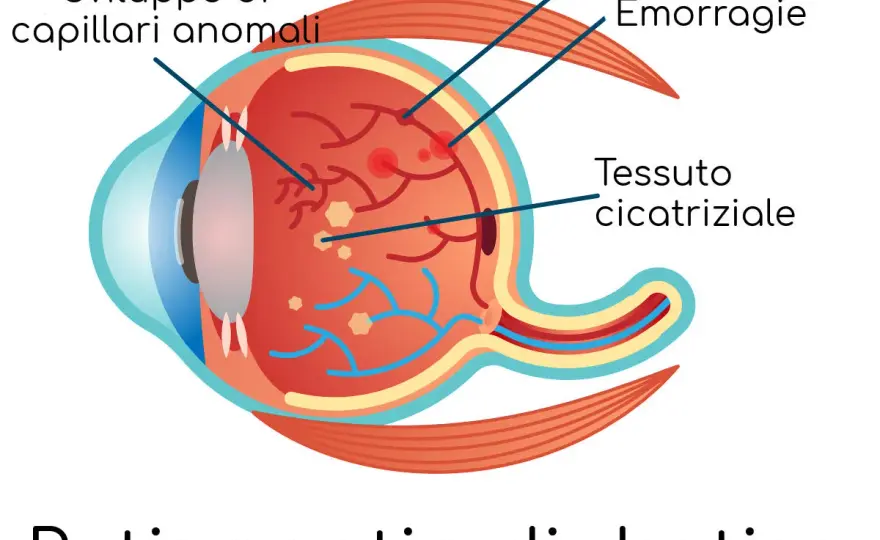 Retinopatia diabetica - sintomi, controlli e cure
