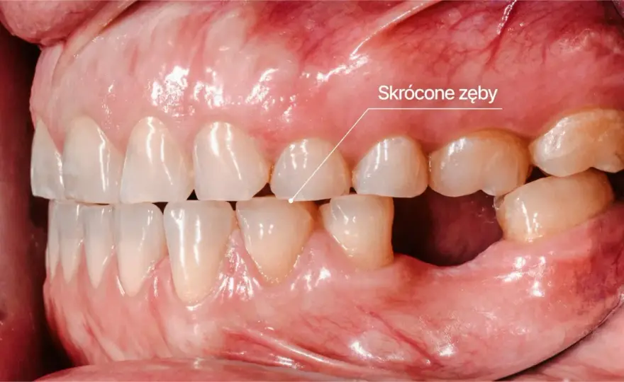 Bruksizm - Zgrzytanie zębami: objawy, przyczyny, leczenie