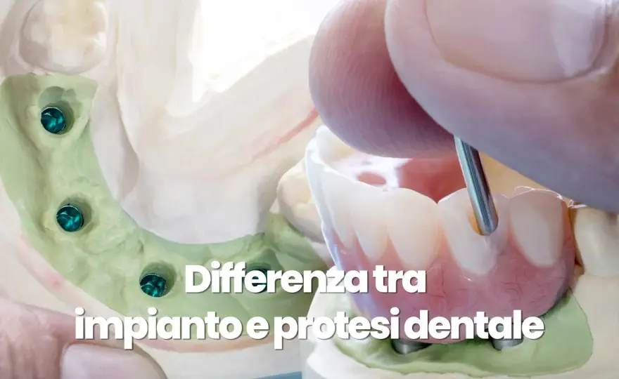 Protesi dentaria, quale scegliere tra mobile, ponte e impianto?