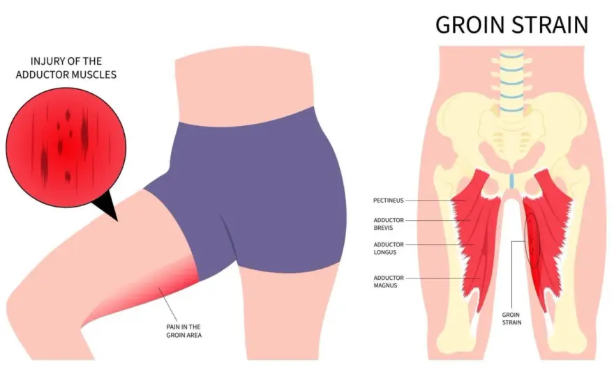 Wo liegt die Leiste? Anatomie, Schmerzen und Warnzeichen