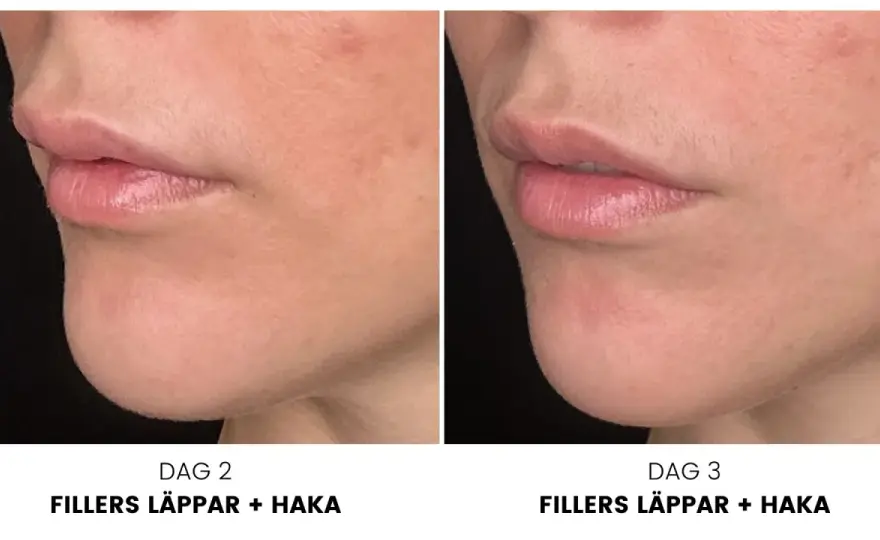 Fillers konsultation - Så får du trygghet & bäst resultat