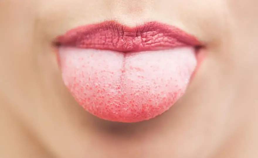 Lingua gonfia da stress? Capire le cause e cosa fare