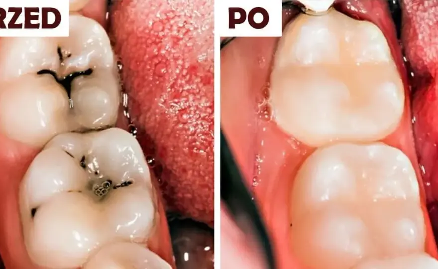 Domowe sposoby na próchnicę: co działa, a kiedy musisz iść do dentysty?