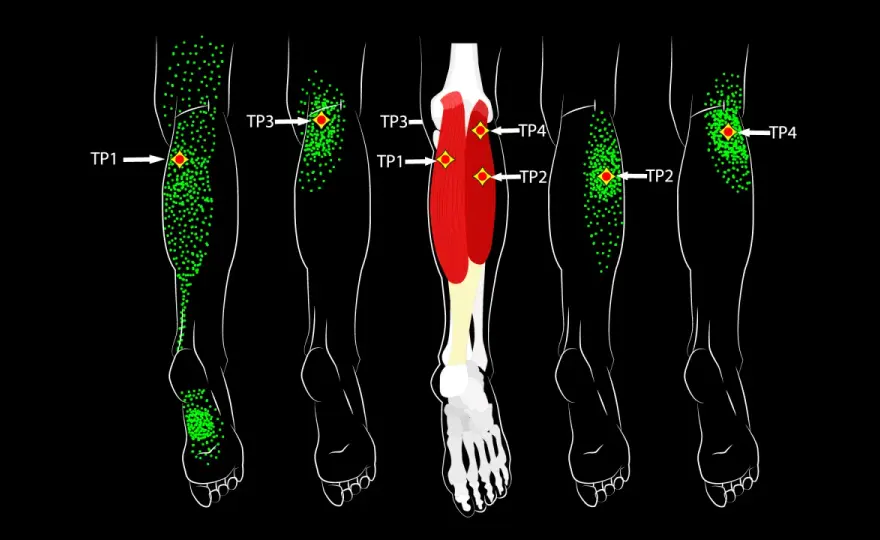 Points gâchettes musculaires - les masser sans aggraver la douleur