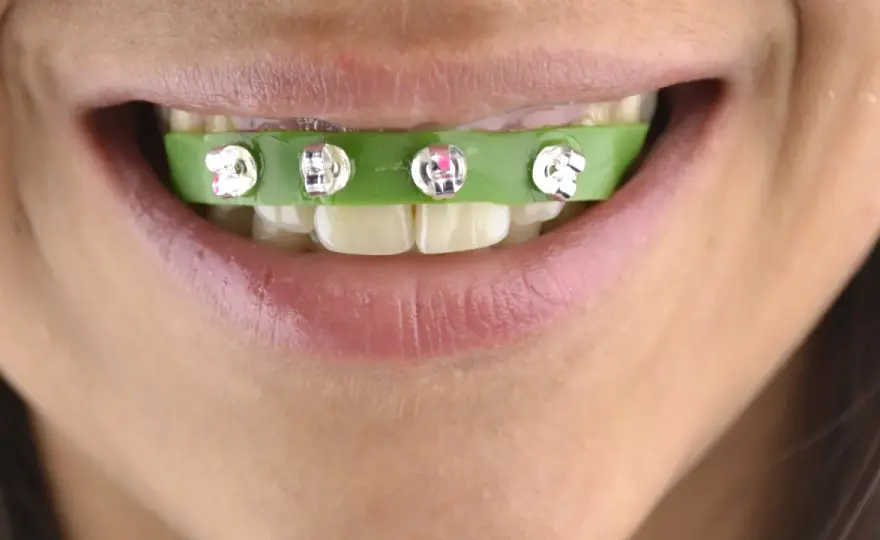 Fake braces: Jak zrobić i dlaczego to zły pomysł?