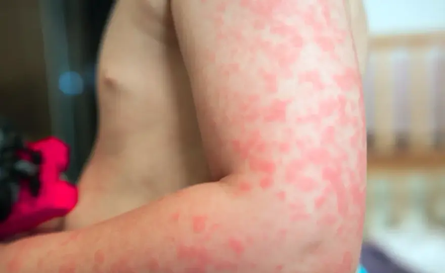 Uczulenie na słońce - To nie zawsze alergia! Sprawdź dlaczego