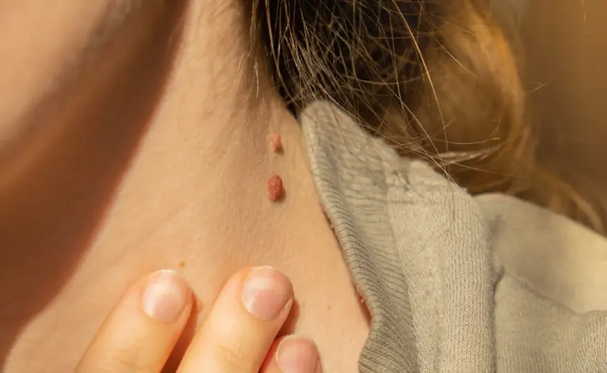 Acrochordon ou grain de beauté ? Les signes qui doivent alerter