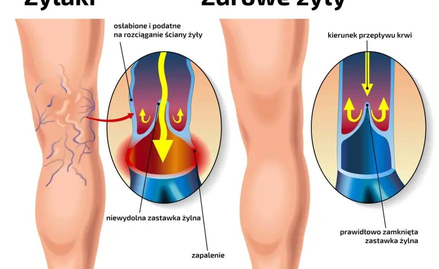 Żylaki na nogach - objawy, leczenie i co naprawdę pomaga?