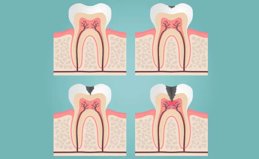 ¿Empaste o endodoncia? Qué necesita tu muela