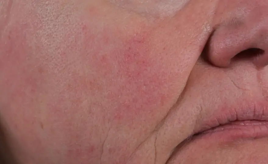 Azelainsyra - Din guide för akne, rosacea och jämnare hud