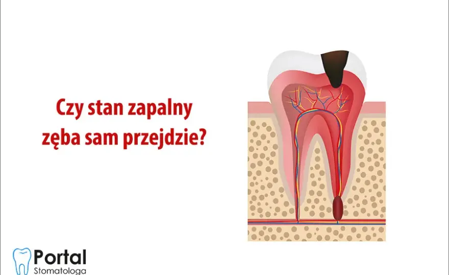 Stan zapalny zęba: Objawy, leczenie, koszty. Czy da się go uniknąć?