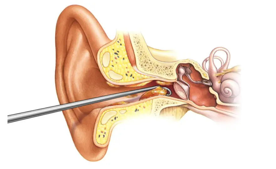 Tapón de cerumen - ¿Cómo quitarlo y cuándo ir al médico?