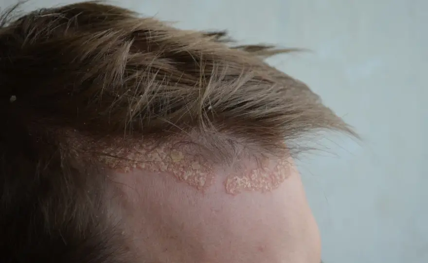 Dermatite seborroica o psoriasi del cuoio capelluto?