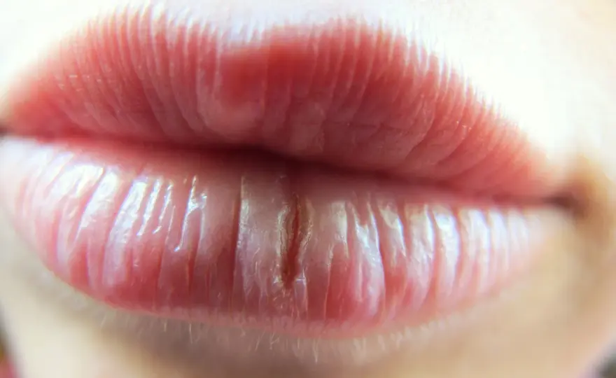 Chéilite - reconnaître les symptômes et savoir quand consulter