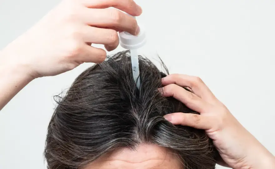 ¿Qué alternativas al minoxidil te convienen según tu caída capilar?