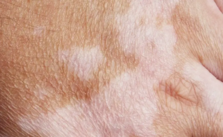 Pigmentflecken verstehen - Ursachen, Formen und was wirklich hilft
