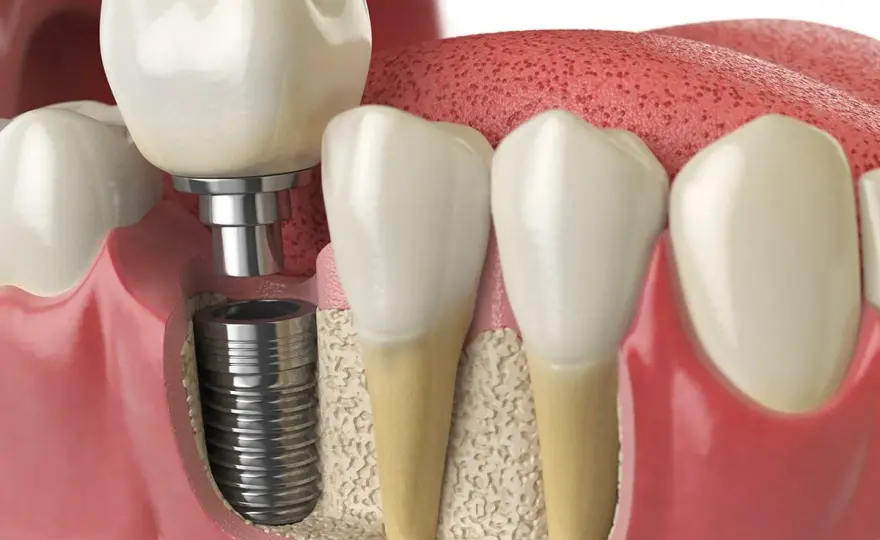 Edentulia - cosa significa e come sostituire i denti mancanti