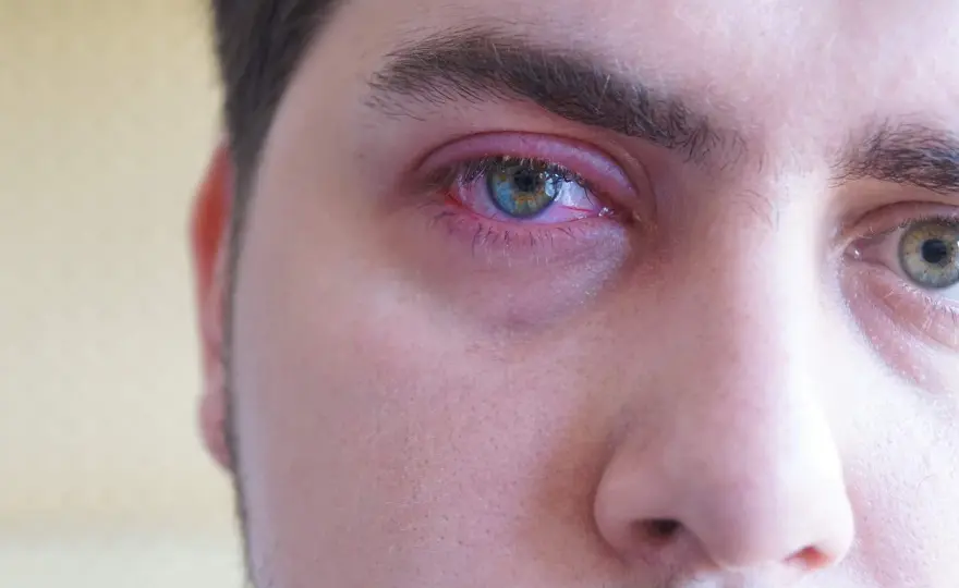 Bolita en la línea de agua del ojo - ¿Qué es y cómo actuar?