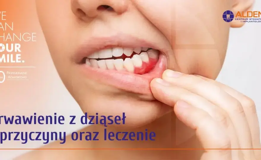 Krwotok z dziąsła? Zatamuj go natychmiast! Przyczyny i porady