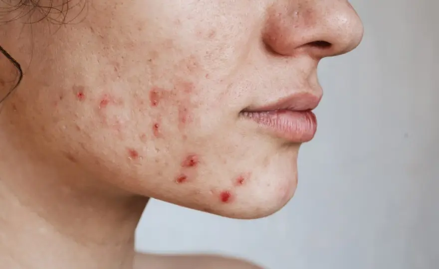 Trądzik hormonalny po 30 - Jak go pokonać i odzyskać skórę?