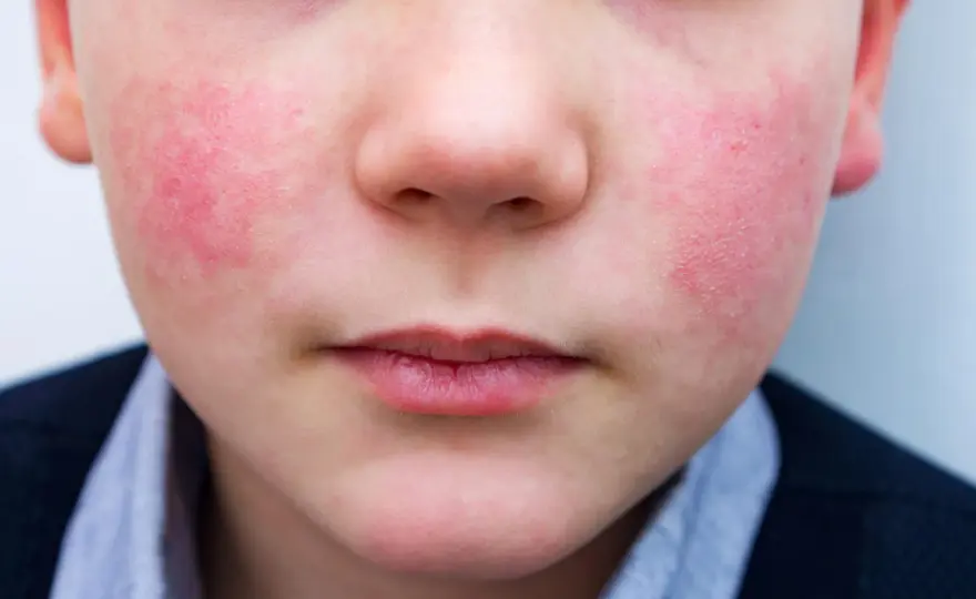 Guance rosse nei bambini - cause e quando preoccuparsi