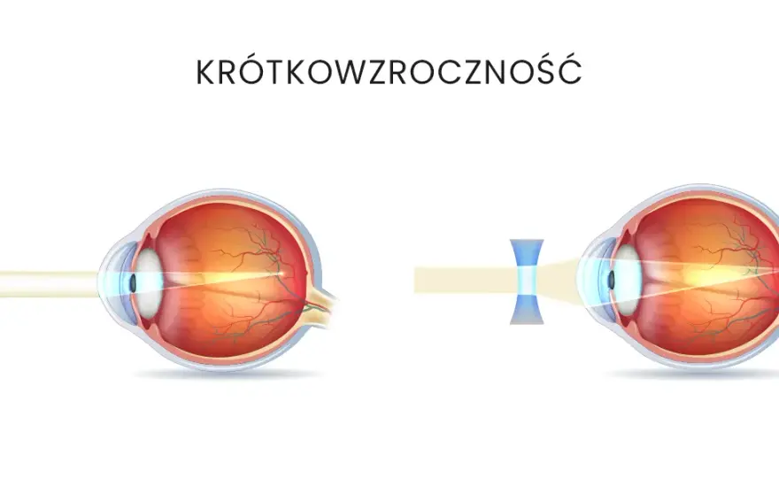 Jak wyleczyć krótkowzroczność i poprawić jakość widzenia?