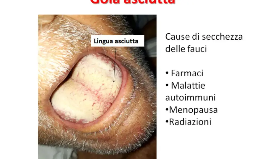 Gola secca, cause e rimedi - quando sentire il medico?