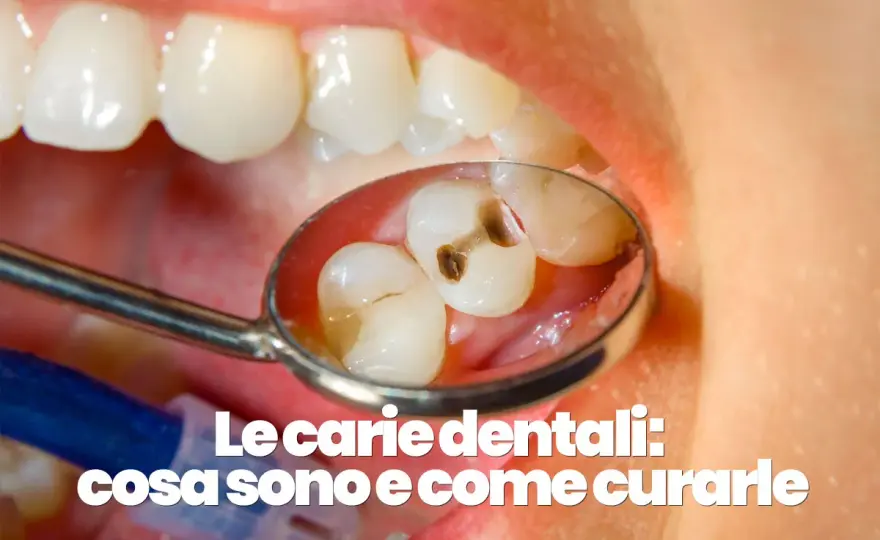 Denti cariati - come riconoscerli e curarli in tempo