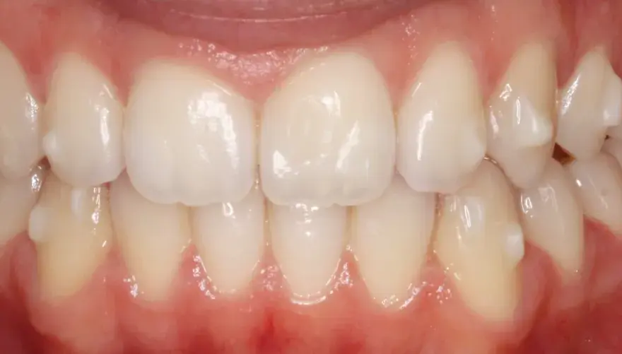 Invisalign sin ataches - cuándo funciona y cuánto cuesta