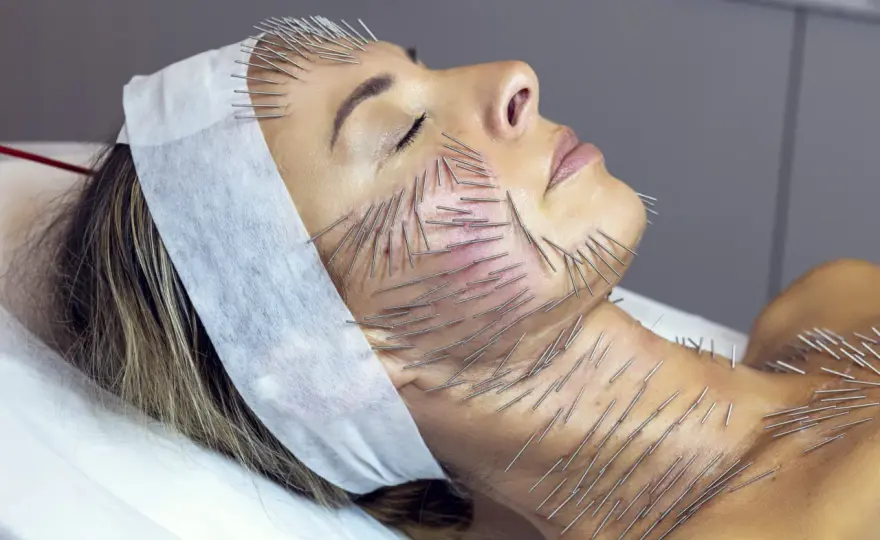 Needle shaping - naturalny lifting bez wypełniaczy