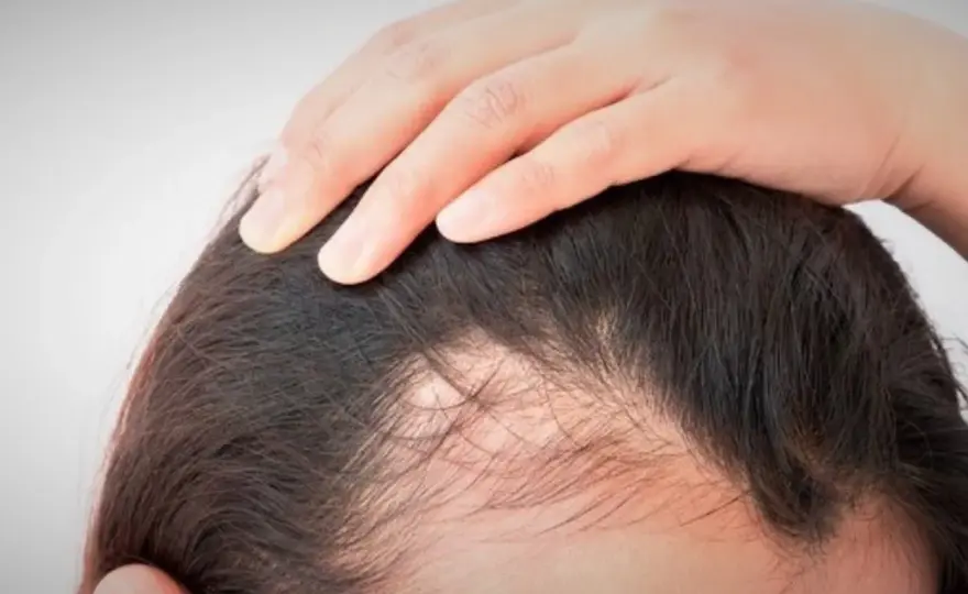 Qué vitamina me falta si se me cae el pelo? Guía clara