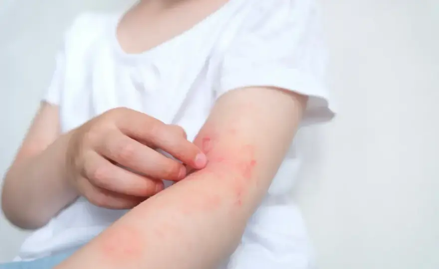 Alergia na nabiał - Objawy, dieta i diagnostyka. Sprawdź!