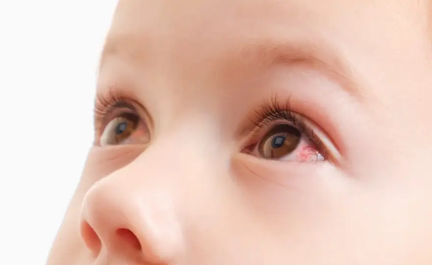 Macchia rossa nell'occhio del neonato - Quando preoccuparsi?