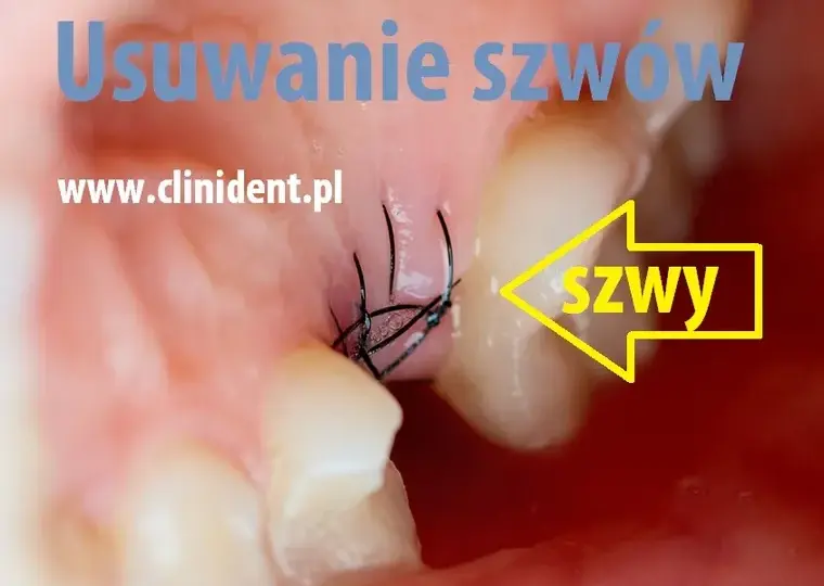 Ile kosztuje zdjęcie szwów u dentysty? Ceny, które zaskoczą!