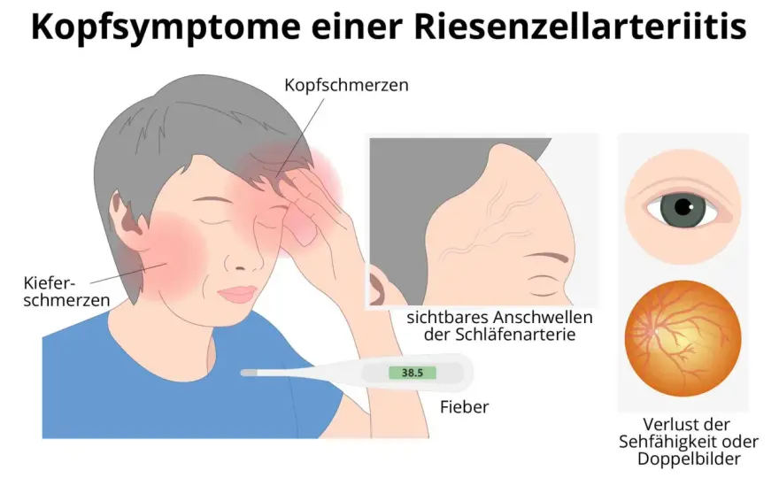 Morbus Horton Diagnostik: Wichtige Kriterien und Symptome erkennen