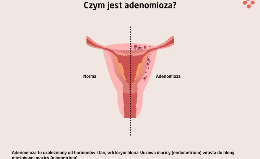 Adenomioza - bolesne miesiączki to nie norma. Poznaj fakty!