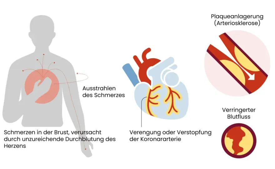 Angina pectoris Symptome erkennen - wann der Notruf nötig ist