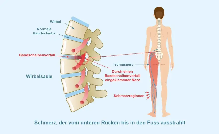 Akuter Ischias - was sofort hilft und was du vermeiden solltest