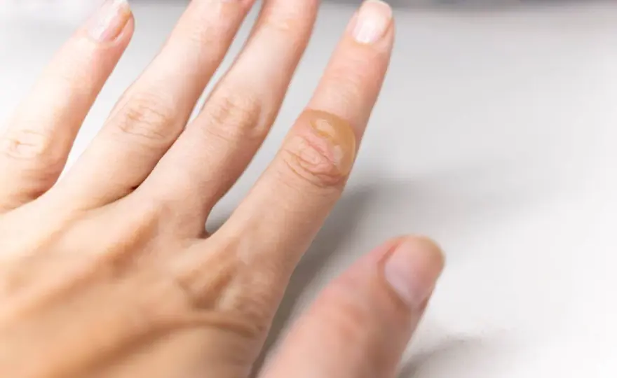 Cloque de brûlure - les bons gestes pour la soigner