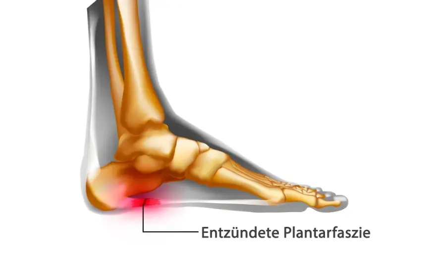 Plantarfasziitis, wenn der Schmerz zunimmt - was jetzt hilft