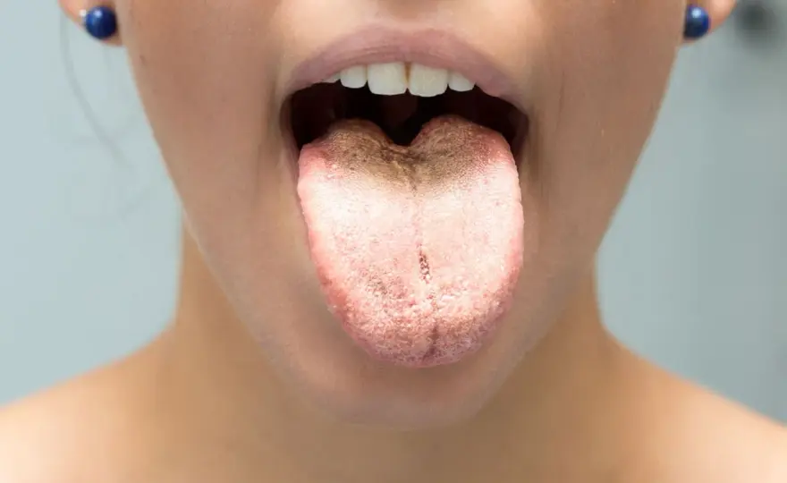 Mughetto sulla lingua, come riconoscerlo e quando curarlo