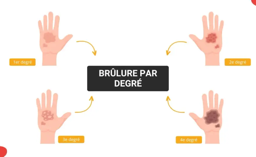 Brûlure du premier degré - les bons gestes à connaître