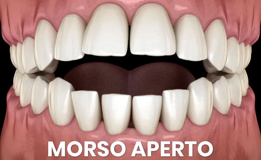 Lingua morsicata, cosa fare e quando andare dal dentista