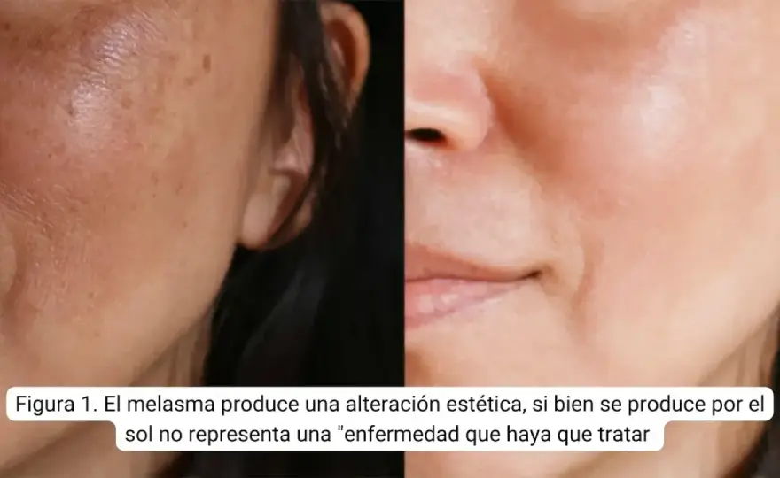 Ácido tranexámico para manchas y melasma, lo que sí puede hacer